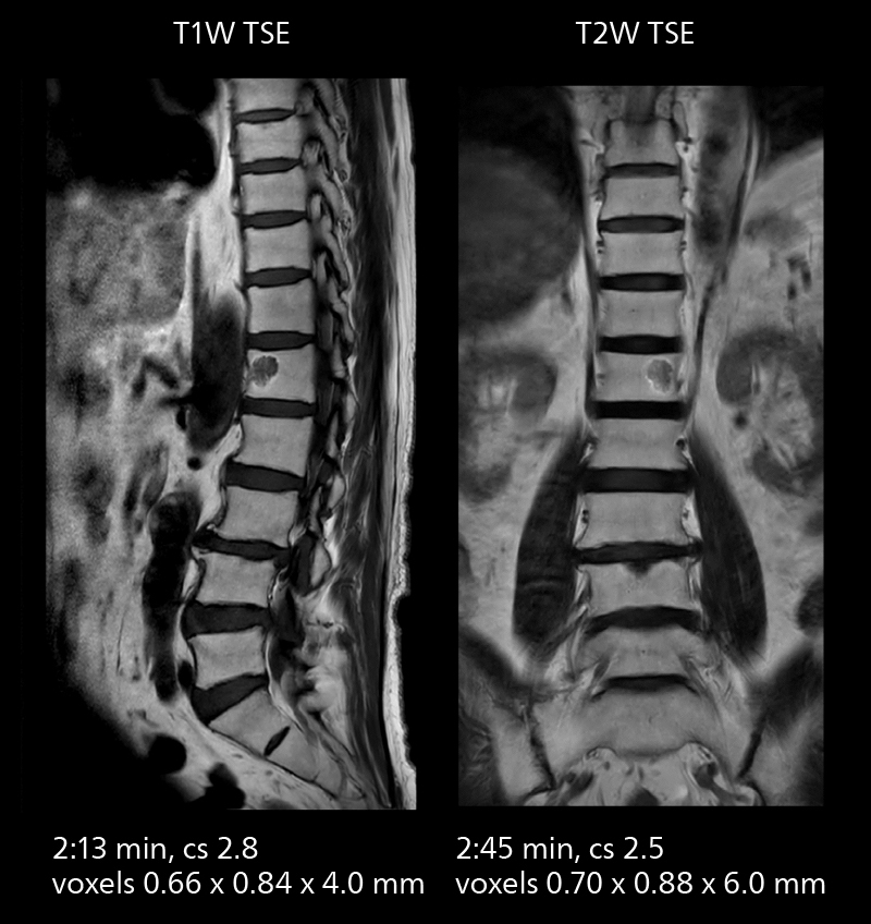Lumbar spine mri two