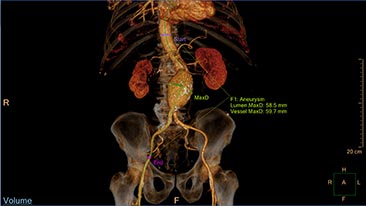 multi modality advanced vessel analysis ava